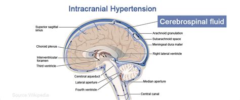 Intracranial Hypertension