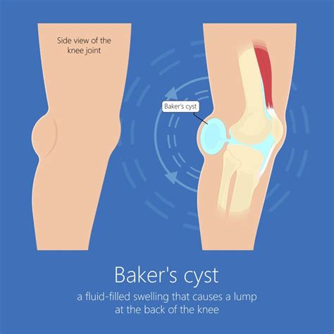 Baker's Cyst Removal at Edwin Kirchner blog