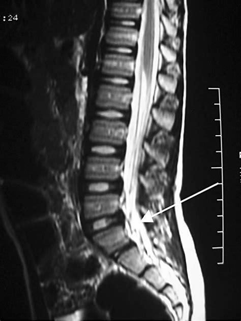 Cervical Nerve Roots Mri