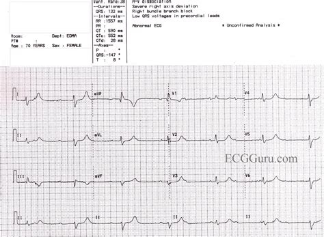 Third-degree AV Block and Junctional Escape Rhythm With Right Bundle Branch Block and Prolonged ...