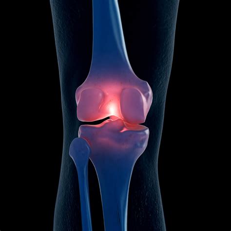 Osteoarthritis Treatment | Northeast Knee & Joint Institute