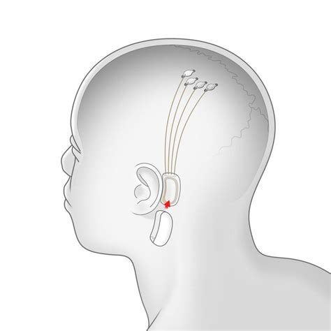 Elon Musk's Neuralink head DRILLING tests begin next year | Human brain, Elon musk, Implants