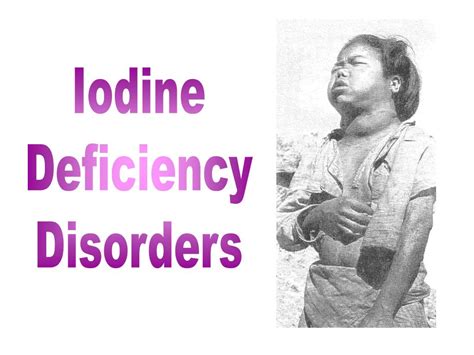 PPT - Iodine Deficiency Disorders PowerPoint Presentation, free download - ID:6771331