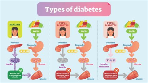 Understanding the Different Types of Diabetes + Prevention Tips | 1MD Nutrition™