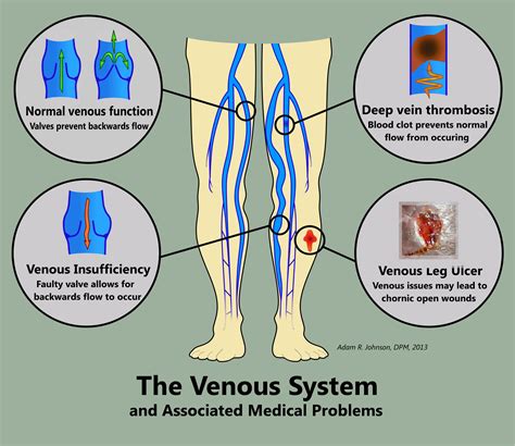 Vein Disease Symptoms