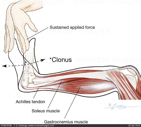 STOCK IMAGE, illustration of ankle clonus in a person with spasticity which consists of rhythmic ...