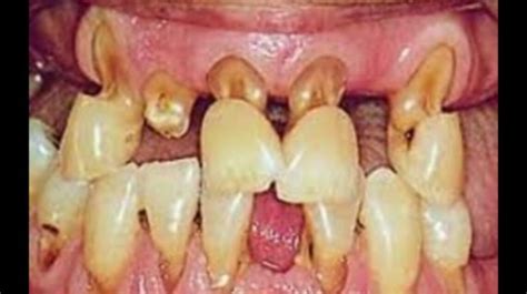 Easy Preventable Dental Disorder - Cervical Abrasion.