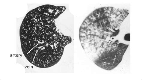 | Computed tomography of centrilobular nodules predominant pattern in... | Download Scientific ...