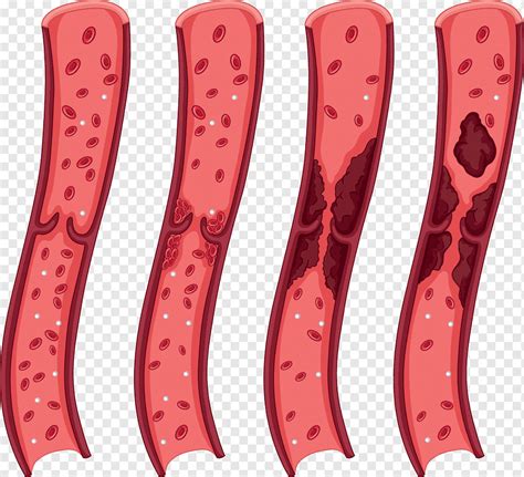Coágulo de sangre en el vaso, diagrama de trombo, png | PNGWing
