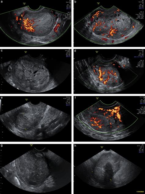 [36+] Uterine Cancer Ultrasound Endometrial Hyperplasia