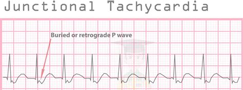 Tachycardia - Causes, Signs, Symptoms, Types, Diagnosis & Treatment