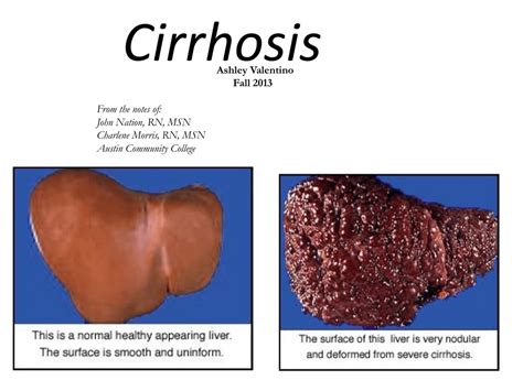 Postnecrotic Cirrhosis