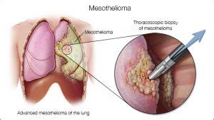 What is Mesothelioma? Best Informative Article | Lawyers Firm USA Blog