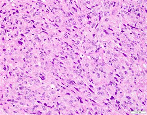 Atypical Fibroxanthoma Histology