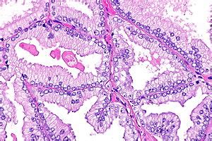 Pseudohyperplastic prostatic adenocarcinoma - Libre Pathology