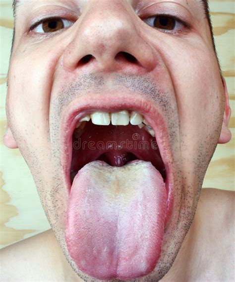 Bacterial Infection Disease Tongue Stock Photo - Image of cavity, geographic: 56417746