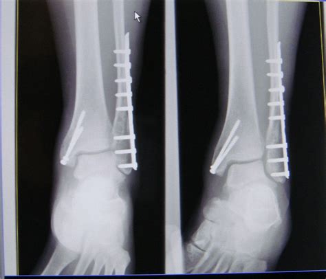 The Ultimate Guide To Trimalleolar Fracture Treatment