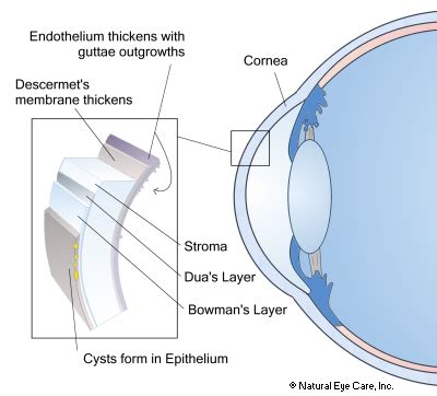 The cornea is comprised of 3 layers of tissue