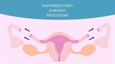 Salpingectomy Surgery Cost In India | Types & Procedure | Medsurge India