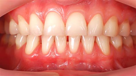 Receding gums causes, prevention and treatments - Dr. Karen Kang, DDS - Ebenezer Dental - New ...