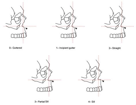 Inferior nasal aperture character states. Note: Dashed lines indicate... | Download Scientific ...