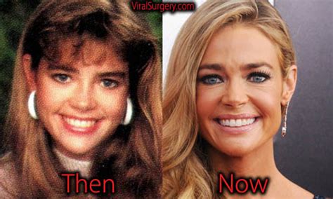 Denise Richards Plastic Surgery, Before and After Boob Job Pictures