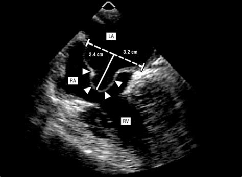 Patent Foramen Ovale in Cryptogenic Stroke: Current Understanding and Management Options ...