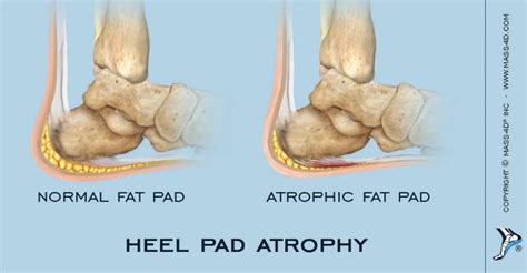 What are some common heel pain causes? | Watsonia Podiatry