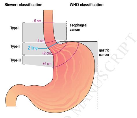 Figure 1 from The surgical management of esophago-gastric junctional ...