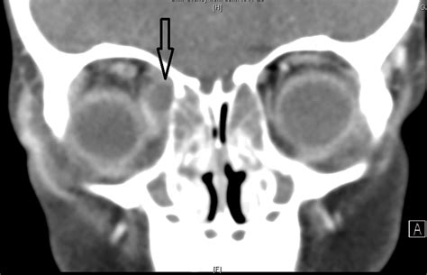 Progressive periorbital swelling, discomfort in 3-year-old male