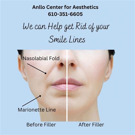 Smooth out your Nasolabial Folds and Marionette Lines!!