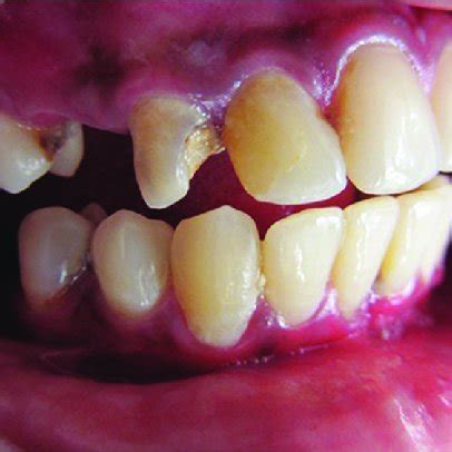 Preoperative view of right maxillary canine | Download Scientific Diagram