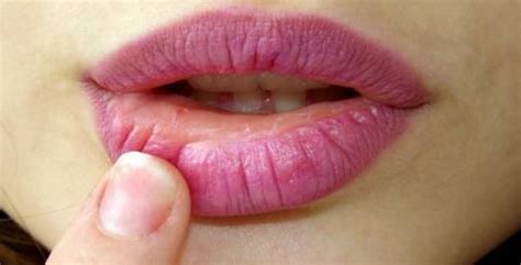 Dry Lip Causes & Dry Lip Treatments - VGFNEWS