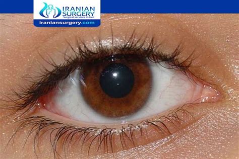 corneal scarring healing time | corneal scar recovery time | Iranian Surgery