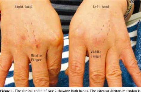 Figure 3 from Boxer ' s knuckle of non-boxer patients - Semantic Scholar