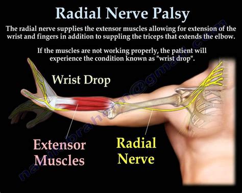 Best 25+ Nerve palsy ideas on Pinterest | Nbcot exam prep, Radial nerve and Hand therapy