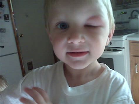 OT pic of my 2yr old's mosquito bite - crazy!!! | BabyCenter