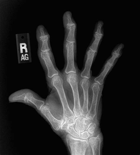 What does hand arthritis look like on x-rays? - Raleigh Hand Center | Raleigh Hand Center