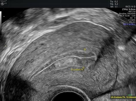 Making the Diagnosis With Endometrial Hyperplasia Ultrasound ...