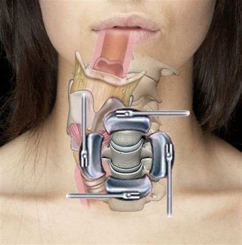 How Does Cervical Spine Surgery Potentially Cause Voice and Swallow ...