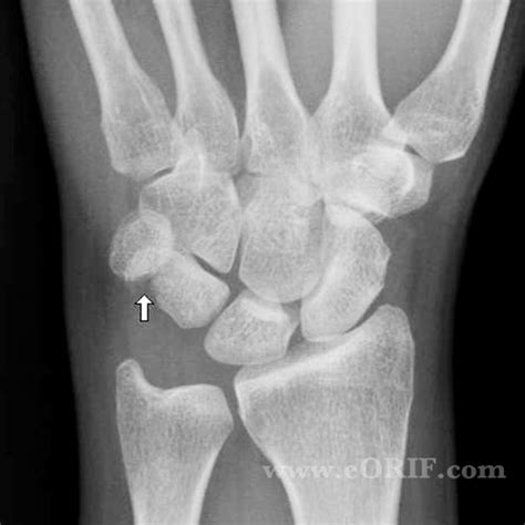 Triquetral Fracture S62.113A 814.03 | eORIF