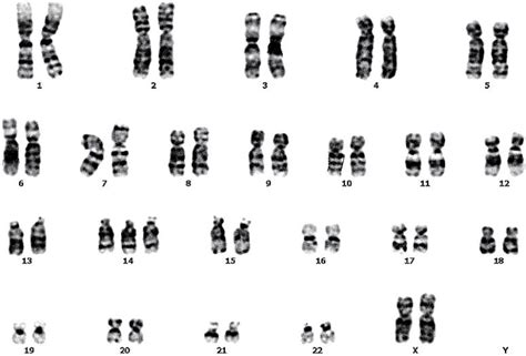 Introduction: Trisomy 14 is a rare chromosome disorder that occurs when an individual has three ...