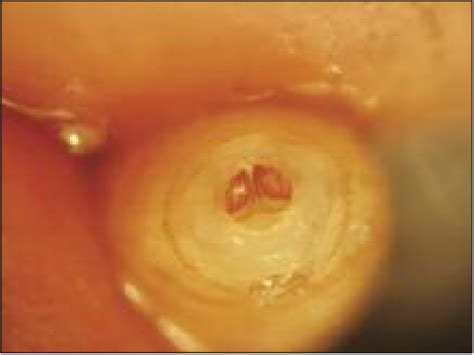 Figure 4 from Oral Myiasis in A Child Due to Wohlfahrtia Magnifica: Original Image | Semantic ...