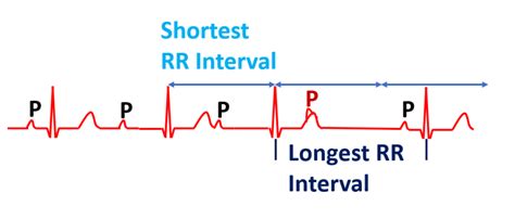 Features of Wenckebach Phenomenon – All About Cardiovascular System and ...