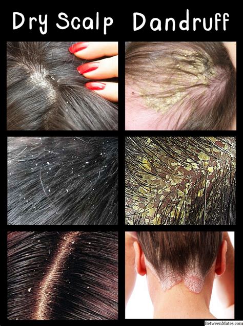 Dandruff Vs Dry Scalp Causes Treatment And Differences Hairstory | Porn ...