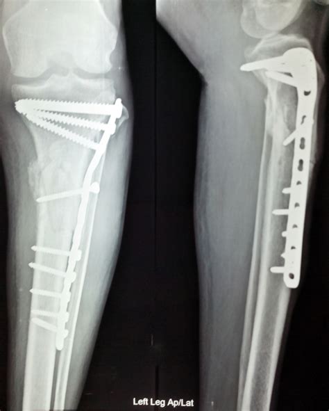 Fracture fixation; Skeletal Fixation