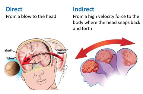 What is a Concussion? – Sports Head Trauma