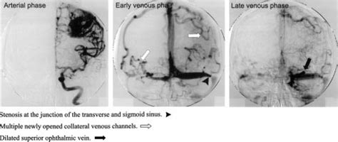 Cerebral angiogram dated 2000. There has been no significant change in... | Download Scientific ...