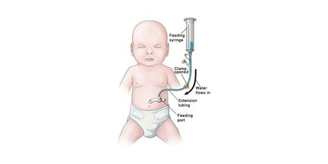 Gastric Gavage Feeding - RNpedia