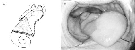 Fasciocutaneous Flap Reconstruction of the Tongue and Floor of Mouth: Outcomes and Techniques ...